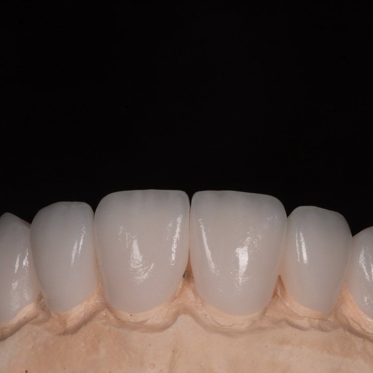 Feldspathic Veneers: The Ultimate Guide