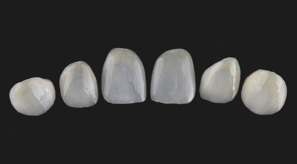 Feldspathic Veneers: The Ultimate Guide