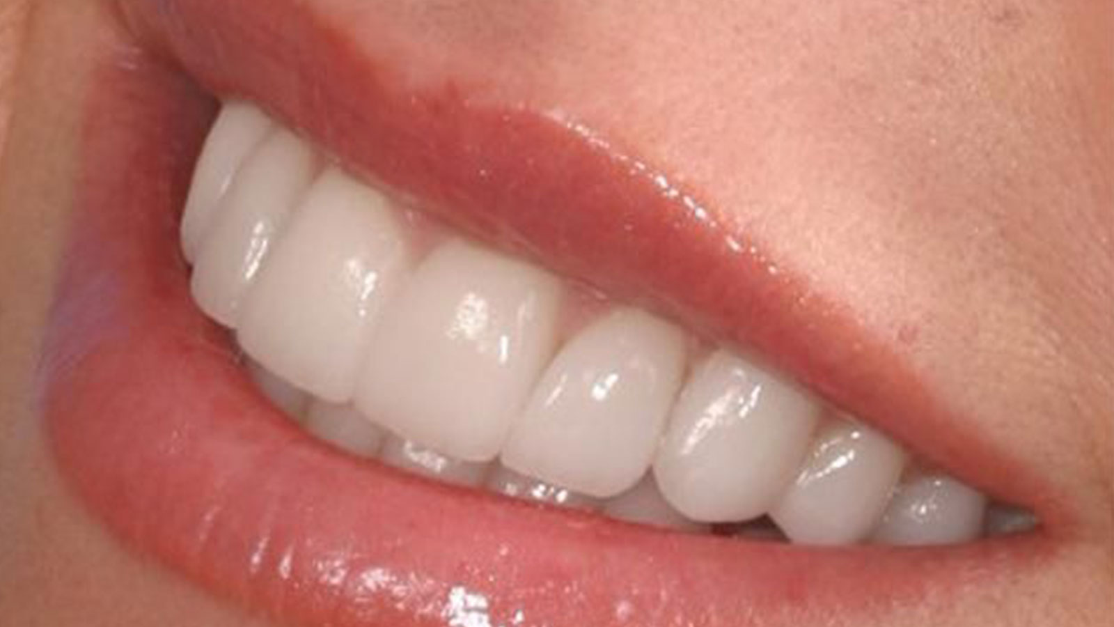 Feldspathic Veneers: The Ultimate Guide