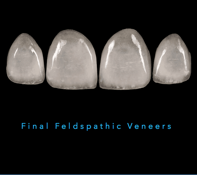 Feldspathic Veneers: The Ultimate Guide