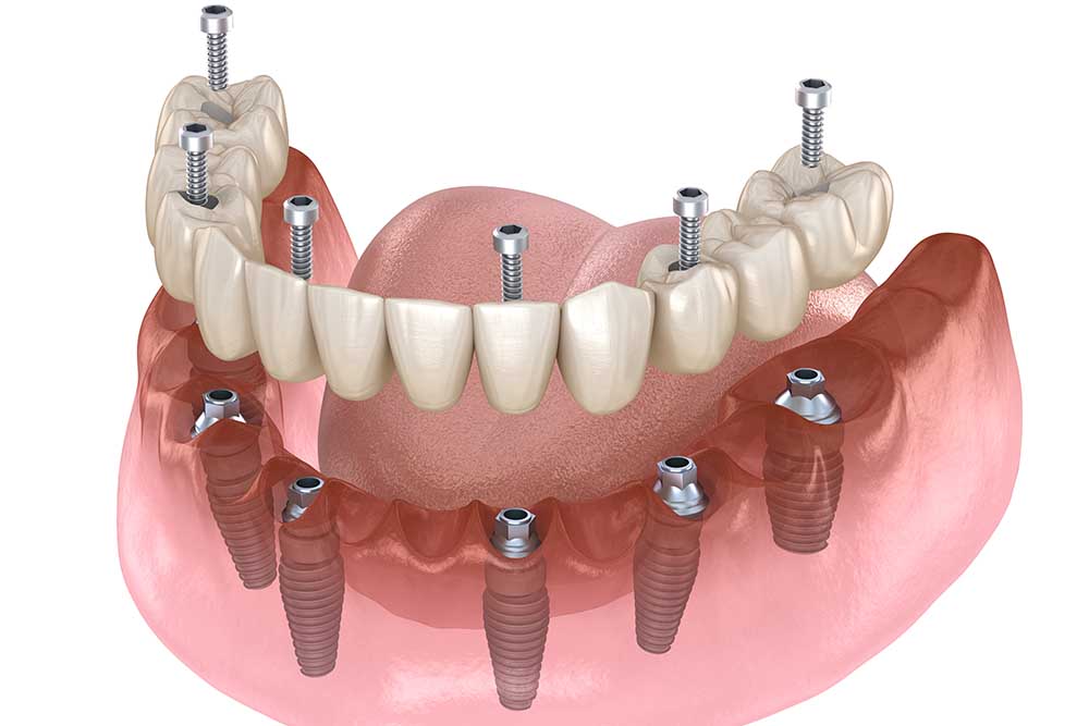 Full Arch Zirconia: A Durable Aesthetic Solution for Missing Teeth