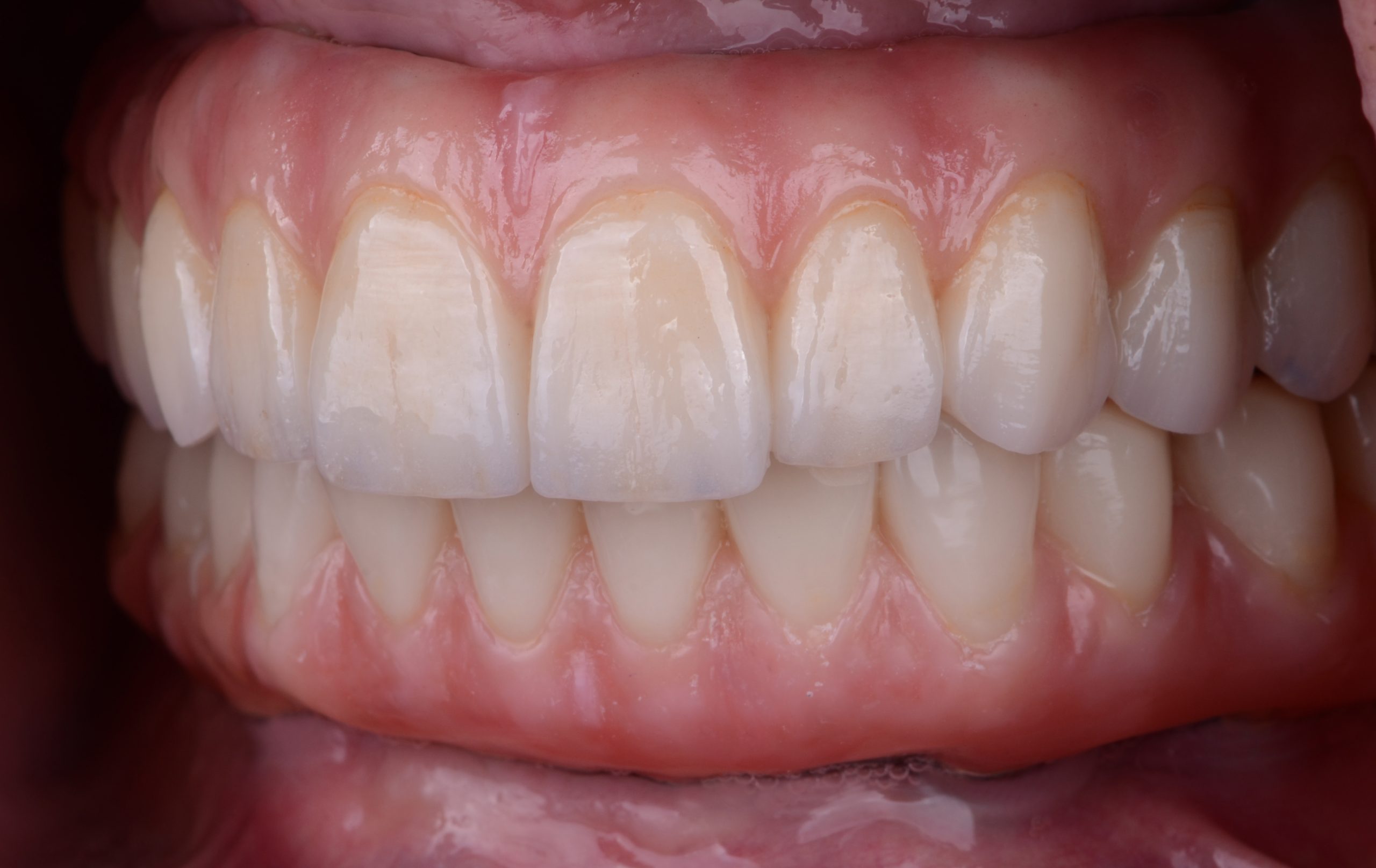 Full Arch Zirconia: A Durable Aesthetic Solution for Missing Teeth