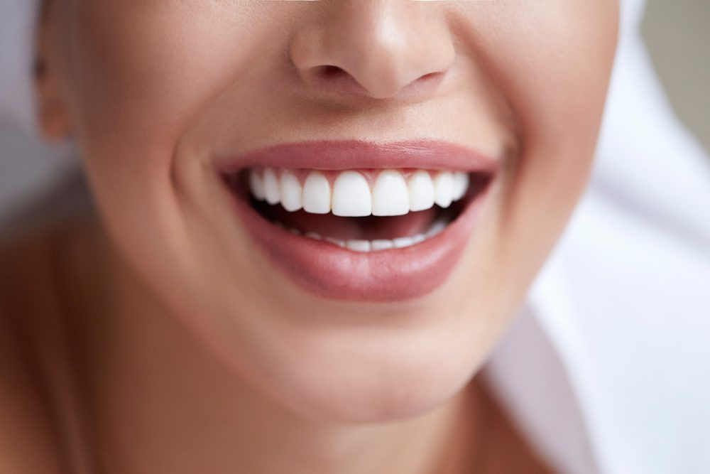 1. DSD Veneers: A Comprehensive Guide