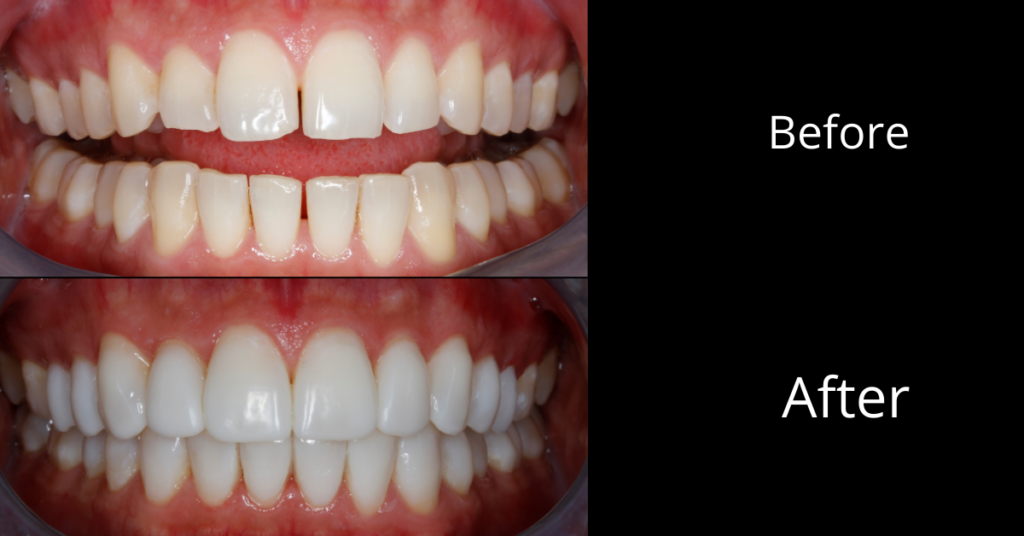 1. DSD Veneers: A Comprehensive Guide