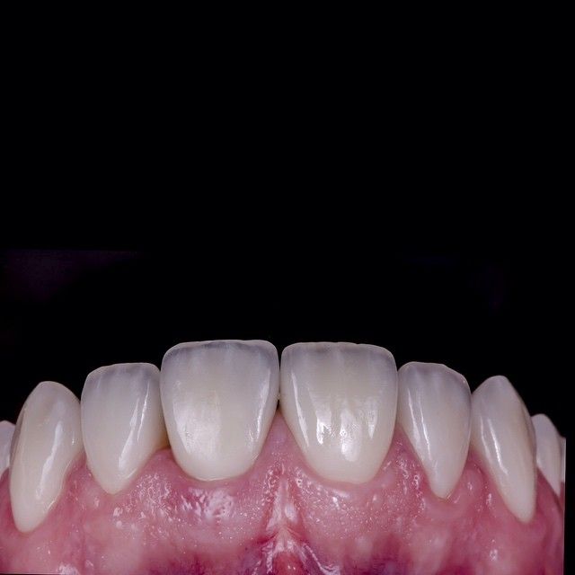 1. DSD Veneers: A Comprehensive Guide