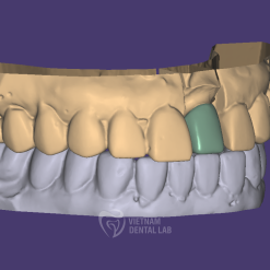 COPING 2 - Crown + Bridge - Vietnam Dental Lab