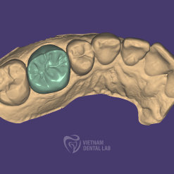 CUTBACK 1 - Crown + Bridge - Vietnam Dental Lab