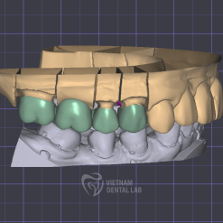 Screenshot 2024 09 23 130823 - Crown + Bridge - Vietnam Dental Lab