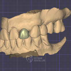 Screenshot 2024 09 26 082335 - Crown + Bridge - Vietnam Dental Lab