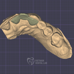 Screenshot 2024 09 26 082556 - Crown + Bridge - Vietnam Dental Lab