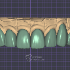 Screenshot 2024 10 04 115451 - Crown + Bridge - Vietnam Dental Lab