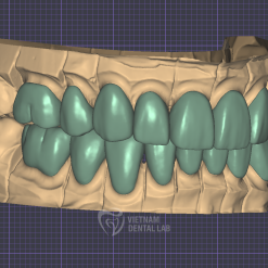 Screenshot 2024 10 04 115611 - Crown + Bridge - Vietnam Dental Lab