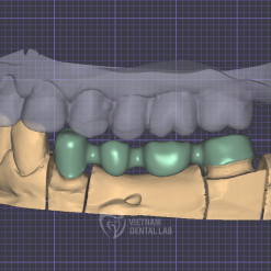 Screenshot 2024 10 04 122529 - Crown + Bridge - Vietnam Dental Lab