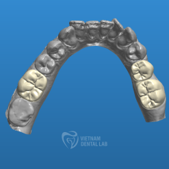 cantilever bridge 1 1 - Crown + Bridge - Vietnam Dental Lab