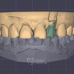image 2024 10 04 124639855 - Crown + Bridge - Vietnam Dental Lab