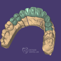 cutback bridge 1 - Crown + Bridge - Vietnam Dental Lab