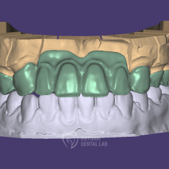 cutback bridge 2 - Crown + Bridge - Vietnam Dental Lab