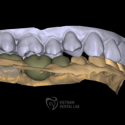 image 2024 09 23 173502913 - Crown + Bridge - Vietnam Dental Lab