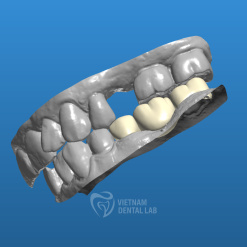 image 2024 09 23 181455205 - Crown + Bridge - Vietnam Dental Lab
