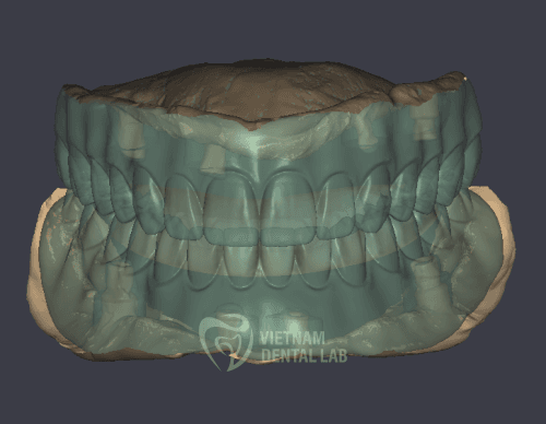 Implant adjustment