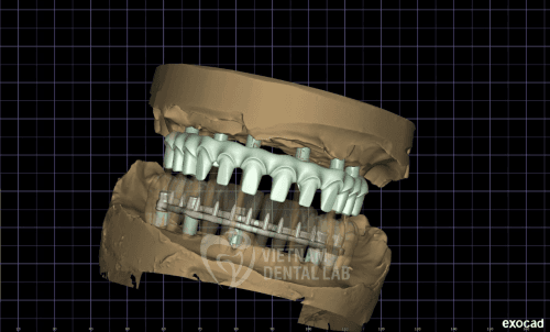 Thimble Implants