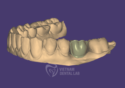Cement-Retained Cutback