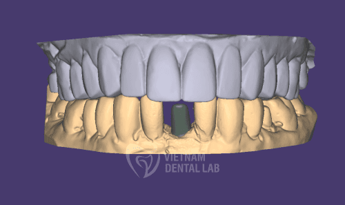 Custom Abutments