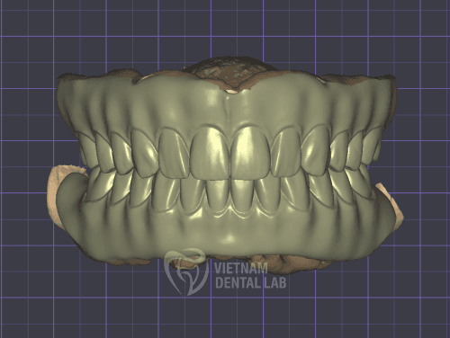 Full design (teeth extra)