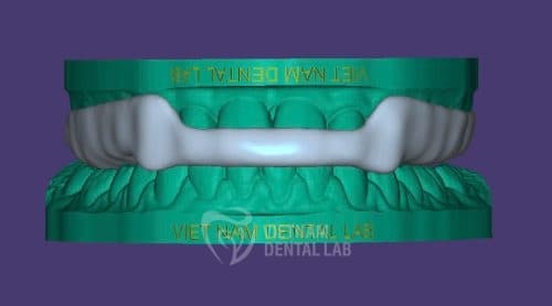 Michigan splints