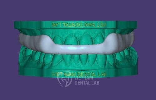 Occlusal splints