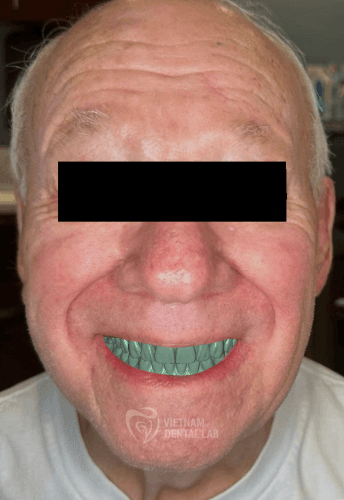 Immediate Denture