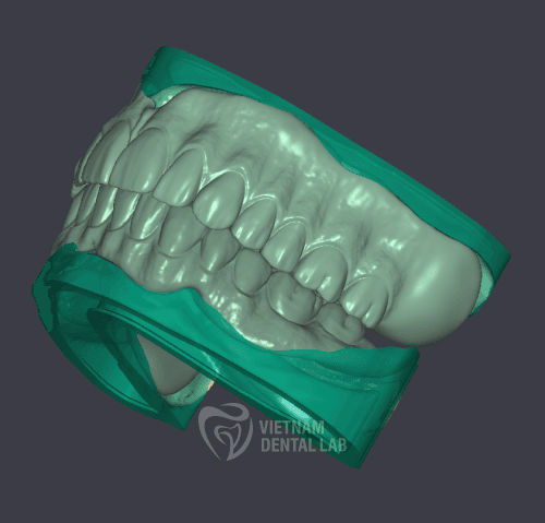Reline denture 2 arch