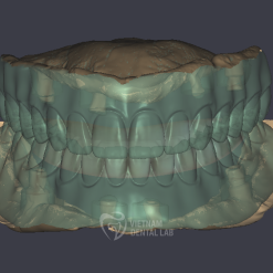 - Vietnam Dental Lab Implant adjustment