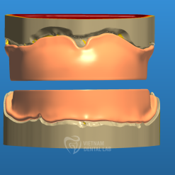 - Vietnam Dental Lab Record Base & Occlusion Rim