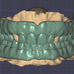 - Vietnam Dental Lab VDO adjustment
