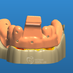 - Vietnam Dental Lab Custom Trays