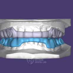 - Vietnam Dental Lab EMA sleep appliances
