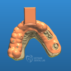- Vietnam Dental Lab Implant Impression Trays