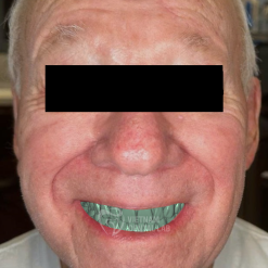 - Vietnam Dental Lab Immediate Denture
