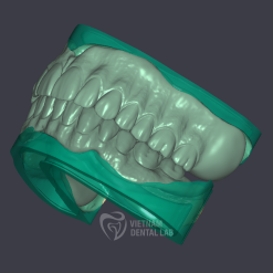 Reline denture 2 arch - Vietnam Dental Lab - Vietnam Dental Lab