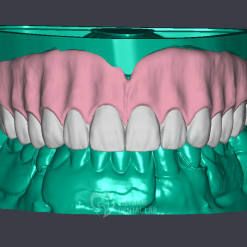 Reline denture and split file - Vietnam Dental Lab - Vietnam Dental Lab