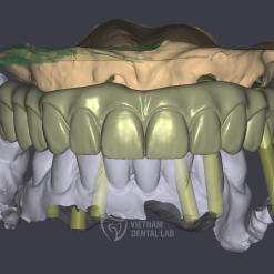 all on x 1 2 - Vietnam Dental Lab - Vietnam Dental Lab