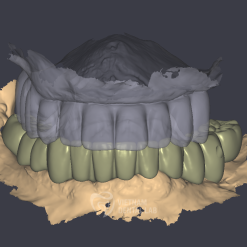 all on x 1 - Vietnam Dental Lab - Vietnam Dental Lab