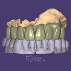 cement retained full contour 1 - Vietnam Dental Lab - Vietnam Dental Lab