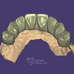 cement retained full contour 2 - Vietnam Dental Lab - Vietnam Dental Lab