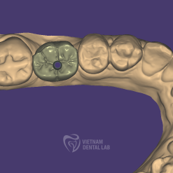 screw retained cutback 1 - Vietnam Dental Lab - Vietnam Dental Lab