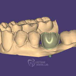 screw retained cutback 2 - Vietnam Dental Lab - Vietnam Dental Lab