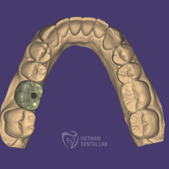 screw retained full contour 1 - Vietnam Dental Lab - Vietnam Dental Lab