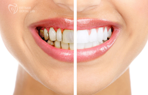 A before-and-after of a stained tooth restored with a crown