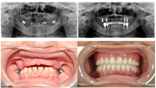 Relining services enhance denture longevity